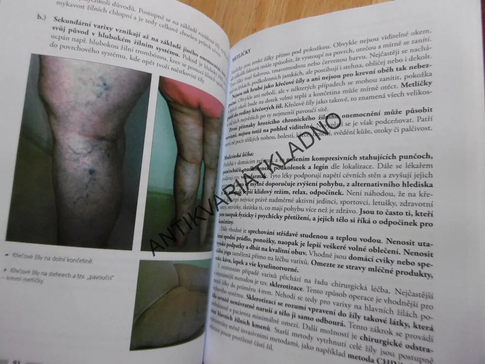 OTOKY A ZÁHADNÁ LYMFA ANEB PRAVÉ PŘÍČINY CELULITIDY, OBEZITY A NEÚSPĚŠNÝCH POKUSŮ ZHUBNOUT, ZDRAVÍ, **an