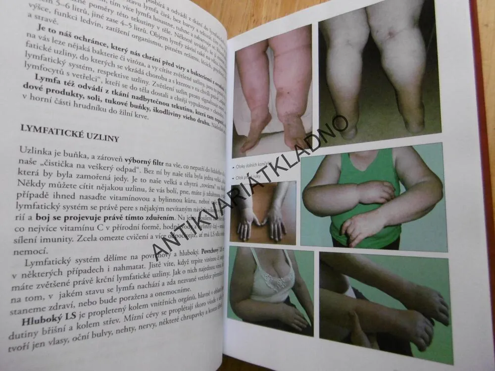 OTOKY A ZÁHADNÁ LYMFA ANEB PRAVÉ PŘÍČINY CELULITIDY, OBEZITY A NEÚSPĚŠNÝCH POKUSŮ ZHUBNOUT, ZDRAVÍ, **an