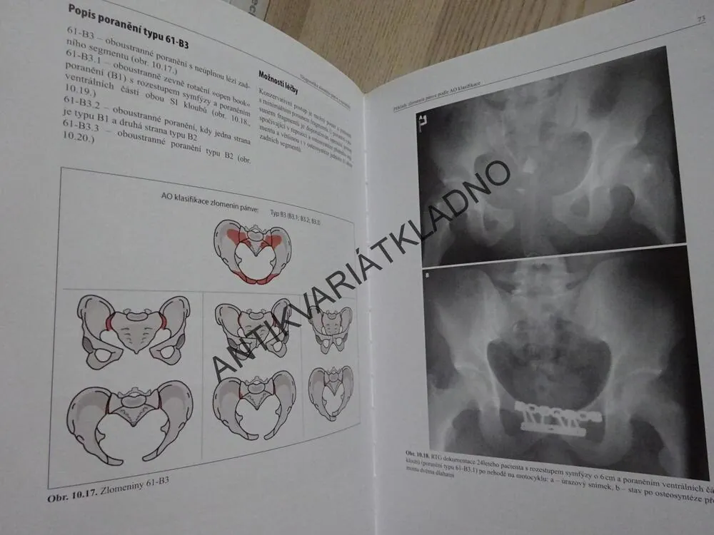 DIAGNOSTIKA ZLOMENIN PÁNVE A ACETABULA, CHMELOVÁ A KOLEKTIV, **an