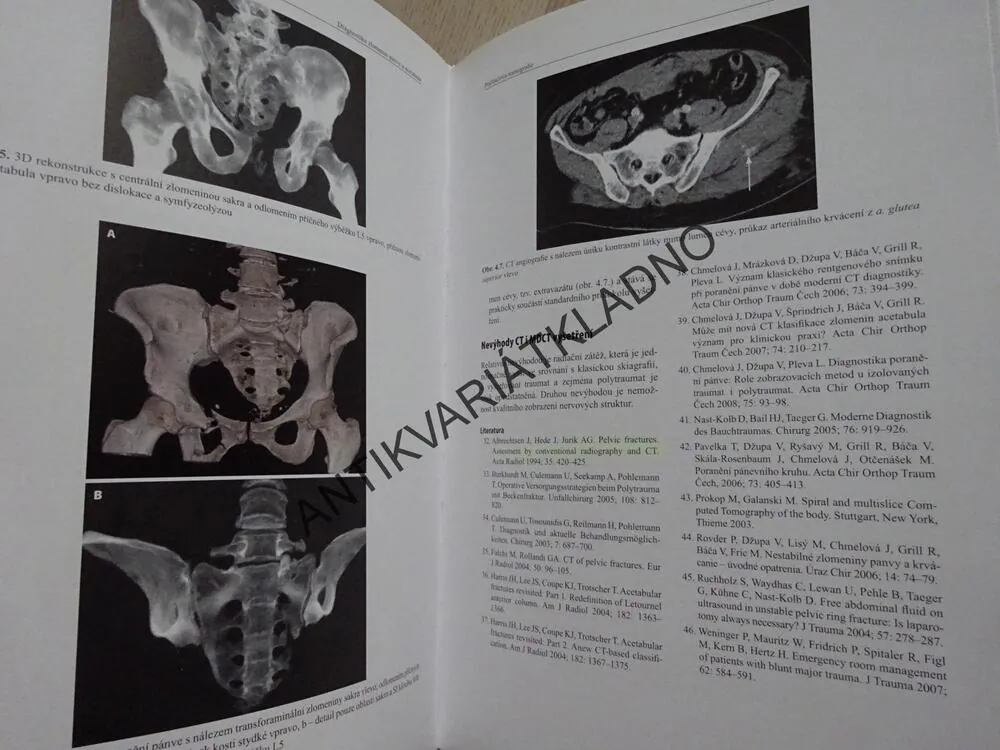 DIAGNOSTIKA ZLOMENIN PÁNVE A ACETABULA, CHMELOVÁ A KOLEKTIV, **an